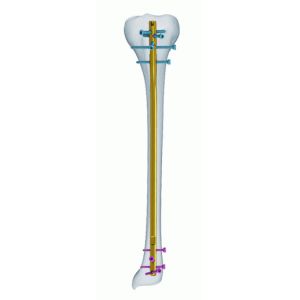 Titanium CE Anatomic Tibia Interlocking Nail