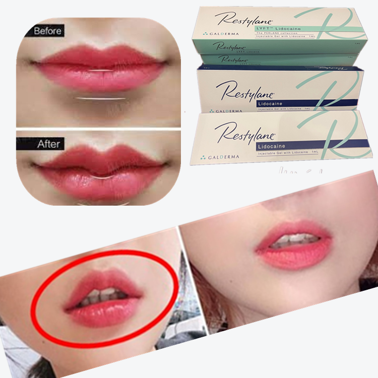2*1ml/Box Cross Linked Dermal Filler For Lips Augmentation
