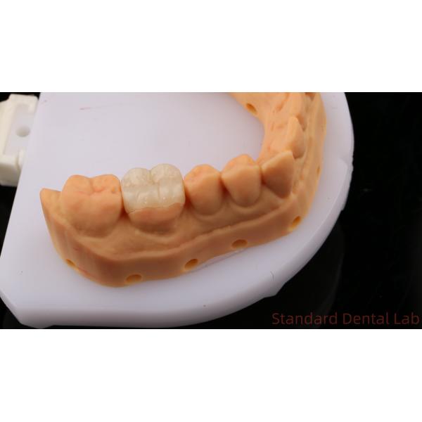 Translucency Zirconia Dental Inlay Onlay Crown For Restore Natural Cavity Shape / Standard Dental Lab
