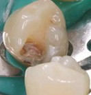 Dental Caries Detection Unit--JR-CL17P