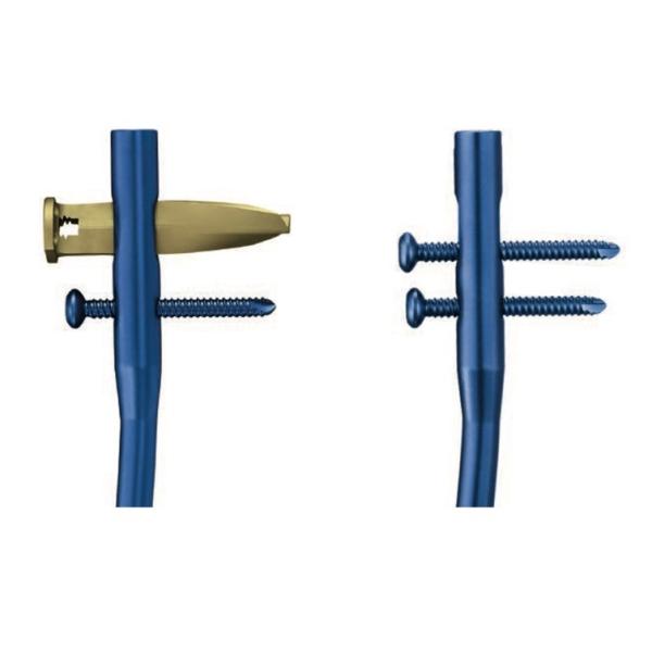 7.0mm 8.0mm Humeral Proximal Intramedullary Nail System Blade Locking