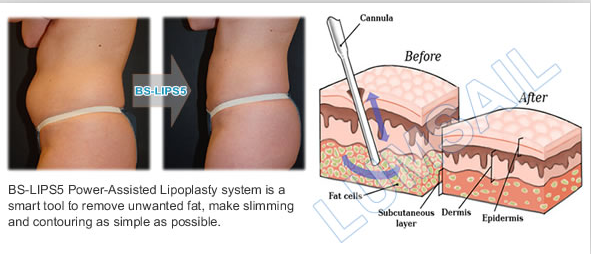 80kg 300W Input Surgical Liposuction Machine For Body Slimming Fat Freezing