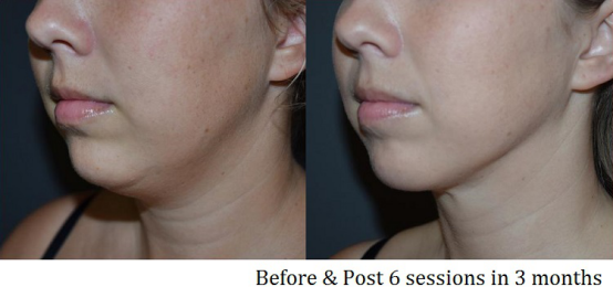 Touchscreen 5 In 1 vacuum cavitation Machine For Stretch Marks