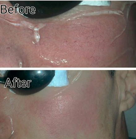 Accurate Software Control IPL SHR Hair Removal Machine With Water Level Monitor