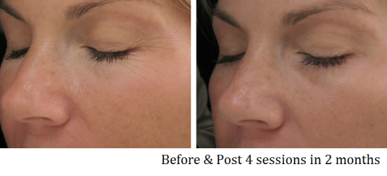 Touchscreen 5 In 1 vacuum cavitation Machine For Stretch Marks