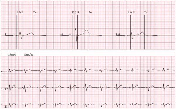Quality Telemetry Bluetooth EKG Check Recorder ECG Loop Recorder Android/IOS System Supported for sale
