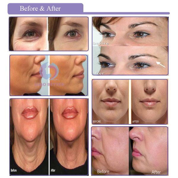Bi Direction COG Skin Threading Face Lift Non Surgical Immediate Effect