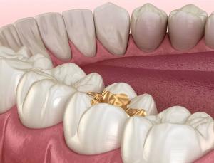 China Gold Inlay Onlay Dental Crown High Noble Yellow Ni Be Free wholesale